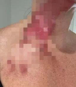 就帮孩子洗了个水壶，澳洲妈妈重伤入院！这个错误很多人都会犯