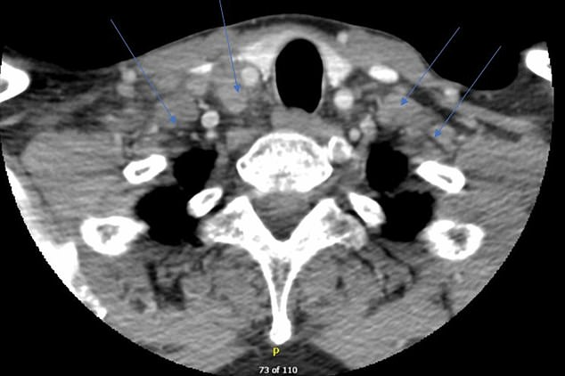 A CT scan of the neck confirmed swollen lymph nodes on both sides, indicated by the blue arrows