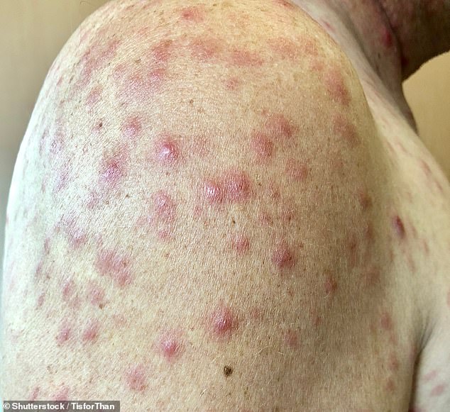 The Northern Territory has recorded 183 cases of syphilis so far this year. Common symptoms include sores, rash and skin lesions (stock)