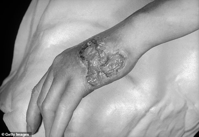 A photograph of a patient with tertiary syphilis resulting in gummatous lesions on the dorsal surface of the left hand. Gummatous lesions due to tertiary syphilis occur many years after initial untreated primary syphilis