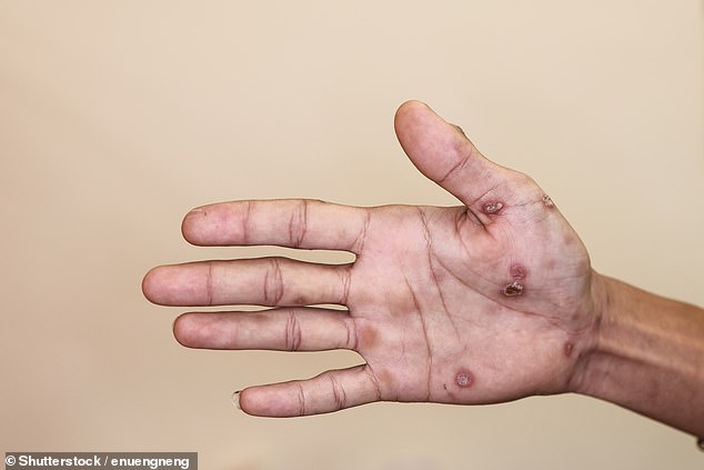 Close up of Secondary stage syphilis sores (lesions) on the palms of the hand
