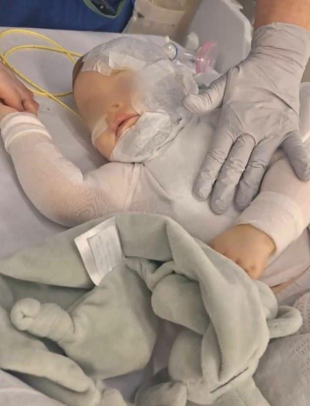 沸腾的液体浇在婴儿卢卡身上后,留下了可怕的伤疤