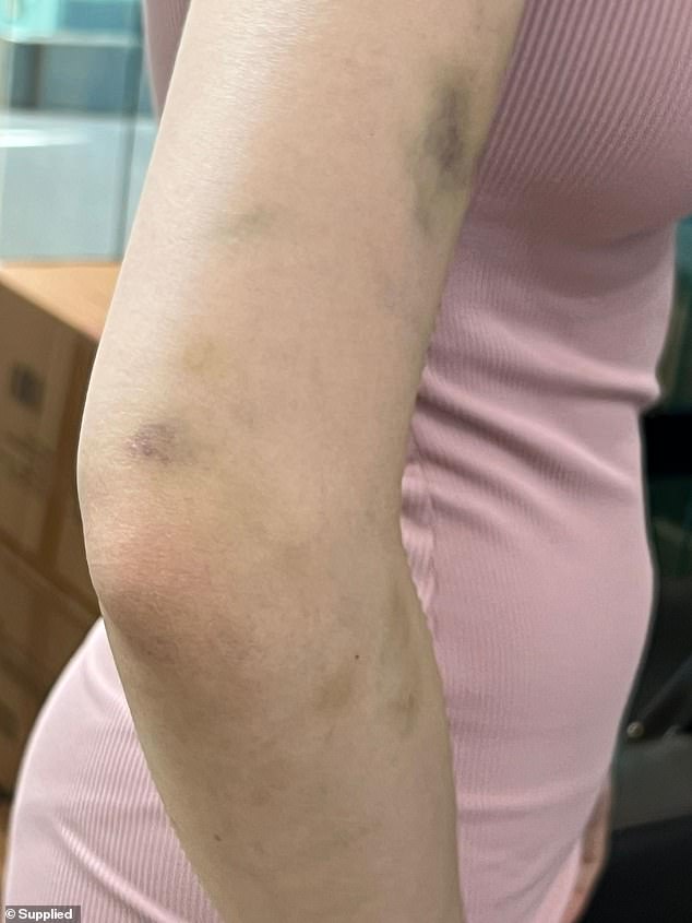 巴比解释说,除了身体受伤外,自从袭击发生后,她就一直无法入睡,并遭受着精神和情感上的创伤。