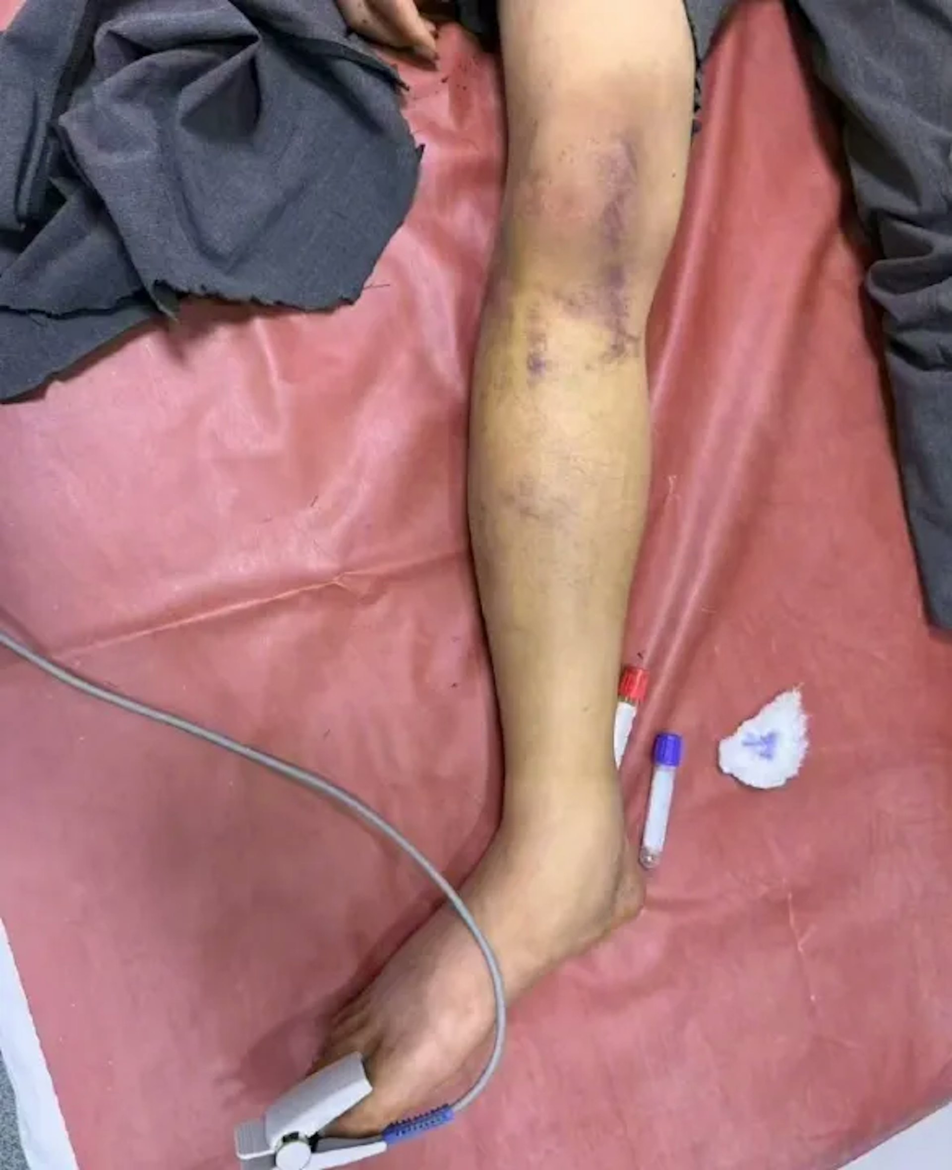 赵某洋事后曾发影片称，花钱找黑人教训对方，没料到对方下手过重打断了曾凡贵的腿。（红星新闻）