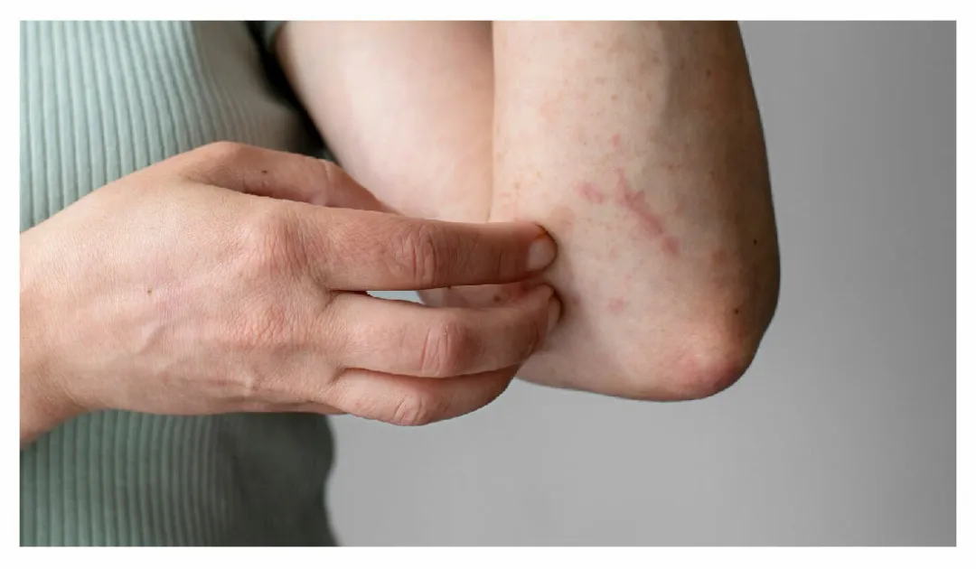 2025麻疹疫情爆發!快速掌握麻疹症狀與預防方法