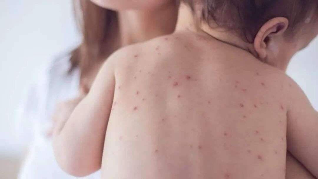 NSW Health issues measles alert after three cases in a week | SBS News