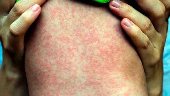 NSW Health issues measles alert after infectious baby flew from Manila,  went to Central Coast