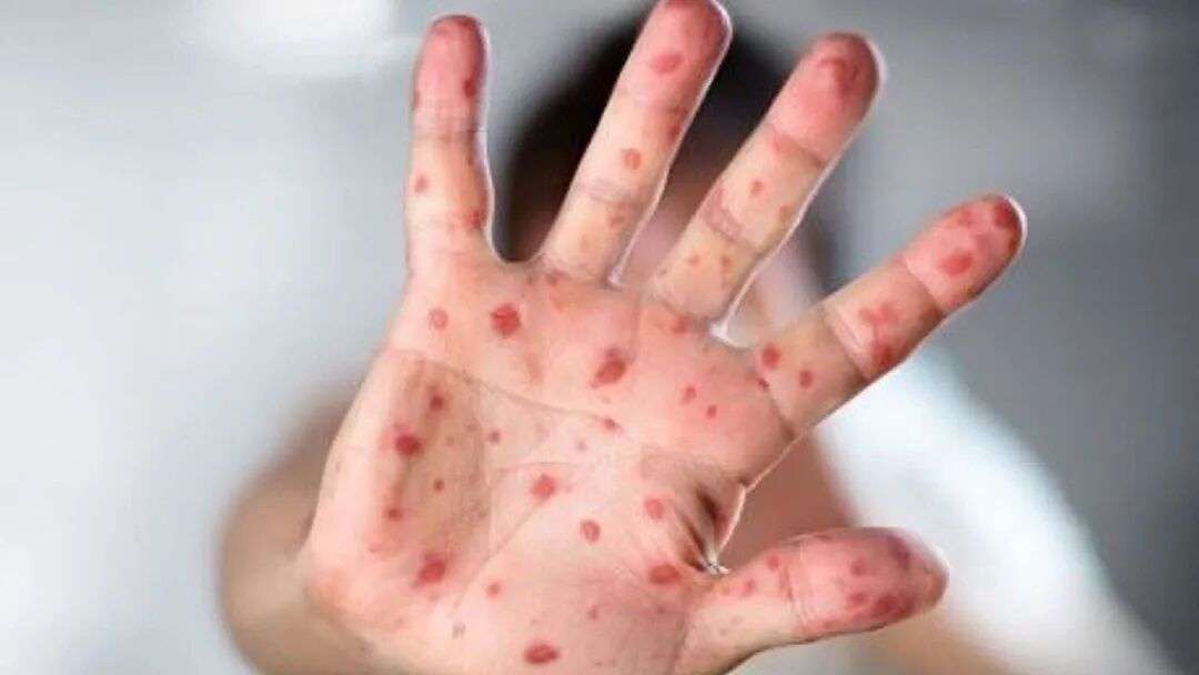 Measles Health Alert Issued in Sydney After Confirmed Case Passes Through  Airport - epardafas.com
